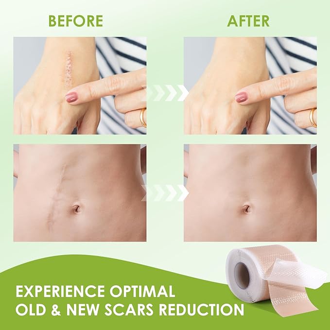 AUSLKA Silicone Scar Sheets(1.6"x 120" Roll-3M),