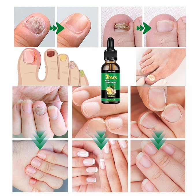 Ginger Nail Treatment Nail Support