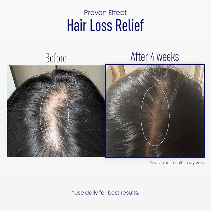 ViveLab Scalp Microneedle Serum – K-beauty Hair Growth & Scalp Treatment with Spioxyl™ 400 | Fills Hair Part Line, Strengthens Roots, Reduces Hair Thinning – 220,000 Microneedle Formula