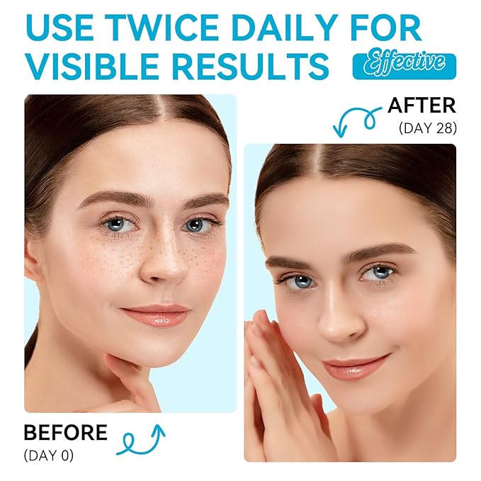 Dark Spot Remover for Face and Body – Dark Spot Corrector Serum for All Skin Types – Fades Age Spots, Sun Spots, Melasma – Anti-Aging Fade Cream for Uneven Skin Tone 1.7 Fl Oz