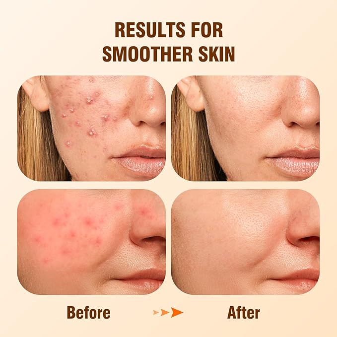 Salicylic Acid 2% Serum Solution for Face: Gently Exfoliating Facial Serum for Acne,Blackhead & Open Pores & Reduces Excess Oil - Hydrating& Soothing Skin Care Serum for Acne Prone&Oily Skin