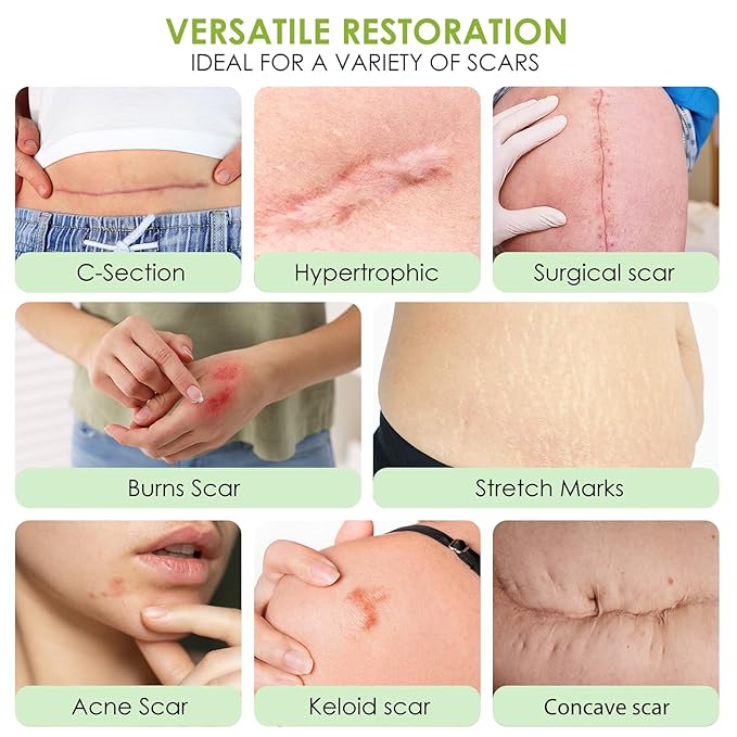 AUSLKA Silicone Scar Sheets(1.6"x 120" Roll-3M),