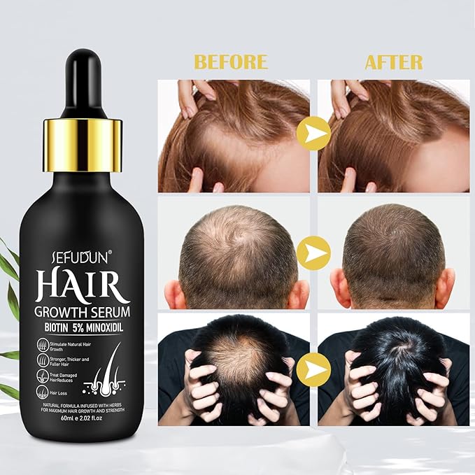 5% Minoxidil Hair Growth Oil for Men and Women - Regrowth Serum, Extra Strength Spray for Hair Loss, Thicker Healthier Hair, Beard Growth Kit, Topical Treatment, 2.02 oz
