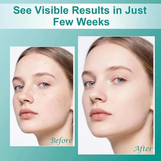 Dark Spot Remover for Face & Body, Dark Spot Corrector- Age Spot Sun Spot Freckles Melasma Brown Spot Remover Skin Care Repair Cream for All Skin Types1.7 FLOZ