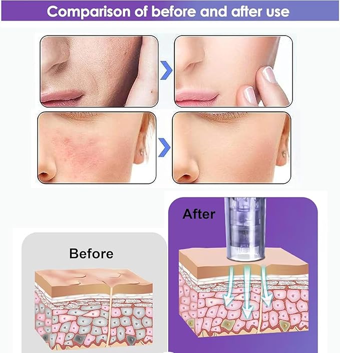 Elitzia Non-Needle Injection Facial Rejuvenation Skin Care Tools Instrument 2 Cartridges for Home Use ETNV6138