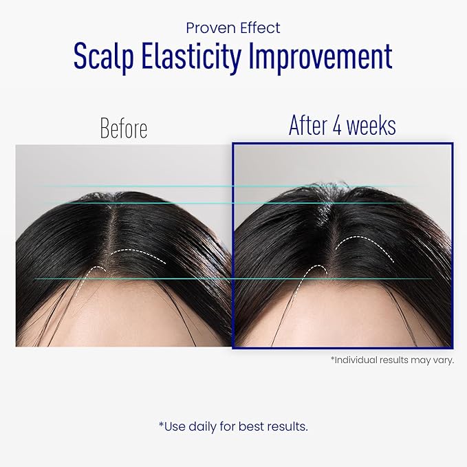 ViveLab Scalp Microneedle Serum – K-beauty Hair Growth & Scalp Treatment with Spioxyl™ 400 | Fills Hair Part Line, Strengthens Roots, Reduces Hair Thinning – 220,000 Microneedle Formula