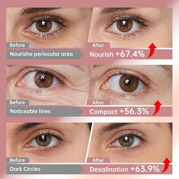 Novoy 15 Pairs Bio-Collagen Real Deep Eye Patches - 6-in-1 Retinol Overnight Eye Patches for Dark Circles, Puffiness & Wrinkles | 2% Caffeine+Hyaluronic+Niacinamide, Korean Popular Eye Mask - ROSE