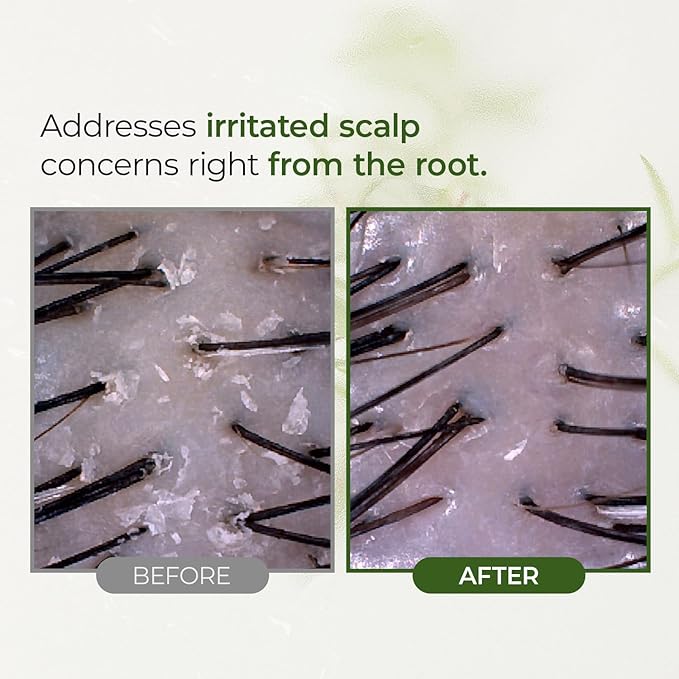 STEAMBASE Tea Tree Scalp Water Scaler | Scalp Exfoliator for Itchy Dry Flaky Scalp, Buildup Remover, Treatment for Excess Sebum Oily Greasy Hair | Korean Hair Care Products, Travel Size, 1.69 fl oz