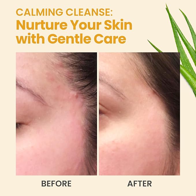 Face and Body Wash for Women and Men - Acne Body Wash Moisturizing for Sensitive Skin - Hydrating Facial Cleanser - Gentle Exfoliating Wash - with Manuka Honey (16oz)