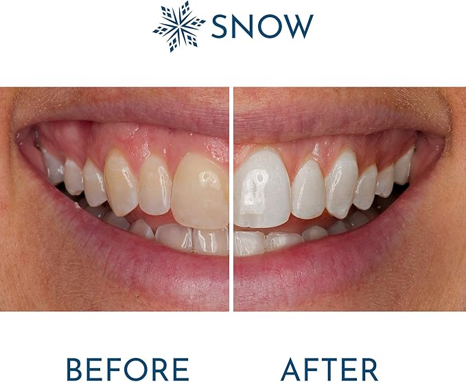 Snow Extra-Strength Teeth Whitening Serum - Oral Care Teeth Whitener Pen - Whitening Pen for Stain Removal & Whiter Teeth - Tooth Whitener with Potassium Nitrate and Hydroxyapatite - 1 Pack