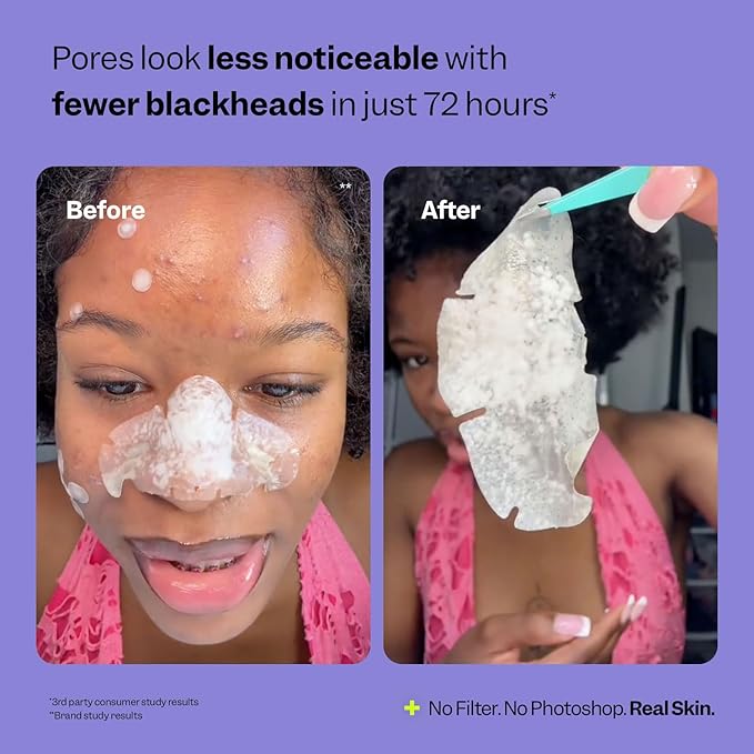 Peach Slices - Nose Pore Patches (7 ct) - Overnight Blackhead Remover - Pore Strips - Absorbs Gunk - Thin, Flexible & Painless - Hydrocolloid Patches - Vegan & Cruelty Free - Korean Skin Care & Beauty