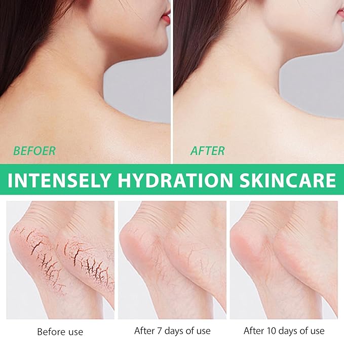 J&H Jasmine&Hyacinth 40% Urea Cream with 2% Salicylic Acid, Aloe, Feet/Heel Cream Moisturizer for Dry Cracked Heel, Knees, Elbows, Hands, Callus Remover, Intensive Hydrating Treatment-5.3 OZ/150 G