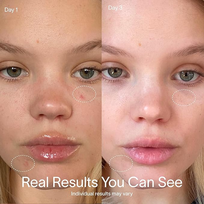 Solawave Bye Acne Spot Treatment | Blue & Red Light Therapy Device for Pimples & Zits | Face Wand Reduces Inflammation, Redness, & Appearance of Blemishes | 3-Min Sessions at Home for Clearer Skin