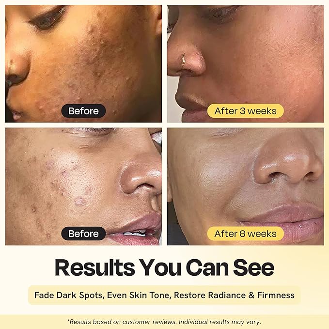 Gleamin Superactive Vitamin C Serum for Face with 15% Vitamin C, Niacinamide, Bakuchiol & Hyaluronic Acid – Skin Brightening Facial Serum for Women & Men – Dark Spot Remover & Radiant Glow – 1 fl oz