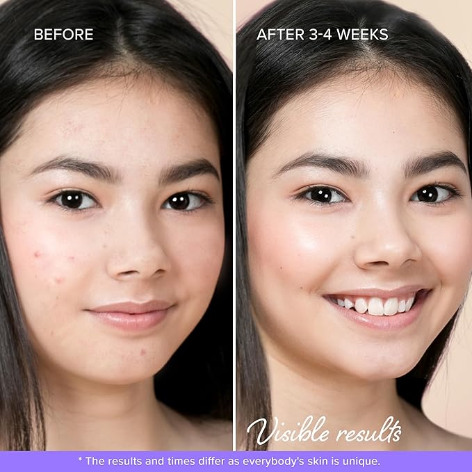 MAREE Star Pimple Patches for Face - Hydrocolloid Acne Patches w/Salicylic Acid, Tea Tree Oil & Centella - Cute Pimple Patches Stars - Teens Zit Patches Stickers - Parches Para Acne - 72 Blemish Dots