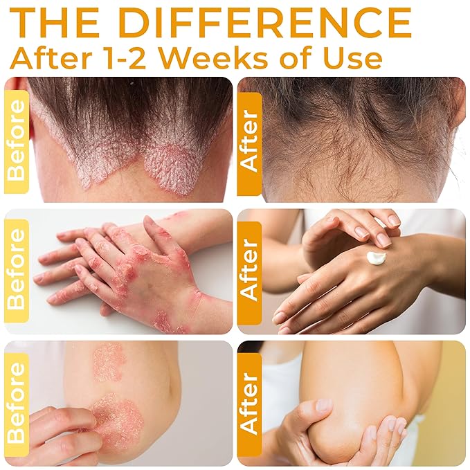 Psoriasis Cream for Itchy Scalp, Face & Body | Eczema Cream for Adults | Psoriasis Treatment for Skin | Itching, Irritation & Redness Relief | XL Size