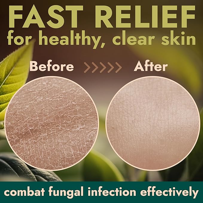 Antifungal Body Wash with Tea Tree Oil | Antibacterial Soap for Back Acne,Treats Ringworm, Eczema & Jock Itch | Antibacterial Body Soap For Men And Women | Includes Silicon Scrubber (16.9 oz)