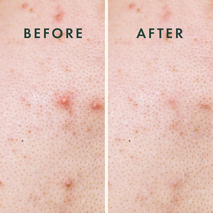 Rael Pimple Patches, Miracle XL Spot Control Cover - Hydrocolloid Acne Patch for Face, Zits & Blemish, Back and Body, Korean Skin Care (8 Count, Pack of 1)