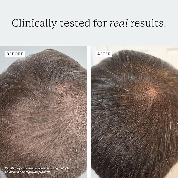 Extra Strength Hair Regrowth Treatment, 5% Minoxidil Solution, 2 fl oz, Unscented, For Men