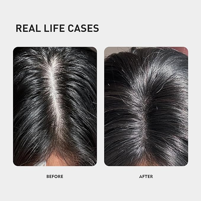 KINTOR 0.9% KX-826 Hair Regrowth Spray,Supporting Healthy Hair Growth,Oil Control, Hair Growth Products Group for Men&Women,Pro,60ml