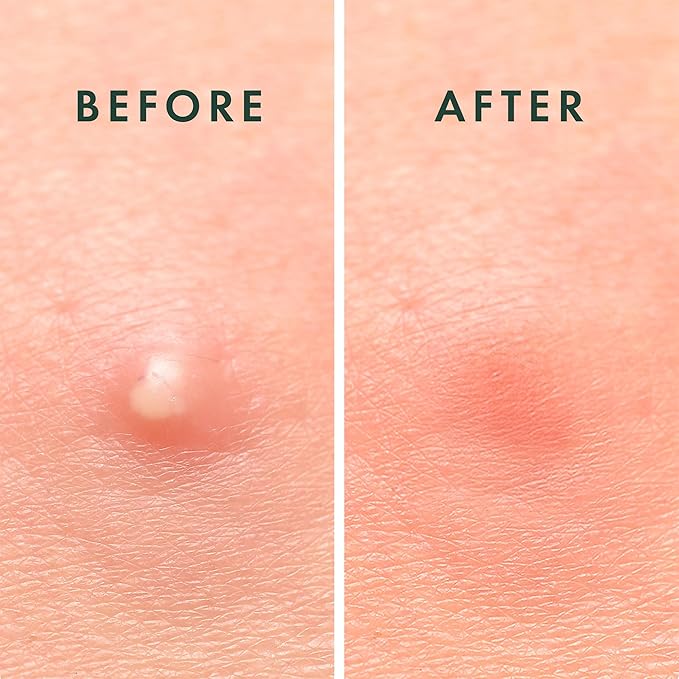 Rael Pimple Patches, Miracle Invisible Spot Cover - Hydrocolloid Acne Patch, Treatment for Breakouts, Absorbs Zits & Blemish, Korean Skin Care, 2 Sizes (24 Count)