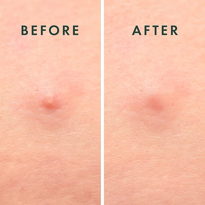 Rael Pimple Patches, Miracle Microcrystal Spot Cover - Hydrocolloid Acne Patch with Tea Tree Oil, Early Stage Zits and Blemish, Korean Skin Care, Vegan, Cruelty Free (27 Count)