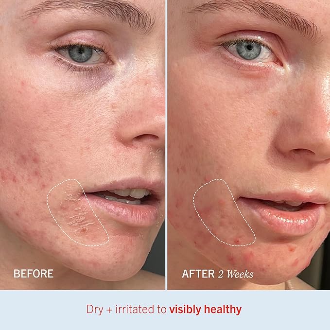 First Aid Beauty - Ultra Repair Cream, Intense Hydration Whipped Colloidal Oatmeal, Clinically Proven to Strengthen Skin Barrier in 7 Days & Helps Relieve Eczema, Luxury Face & Body Moisturizer, 12 oz