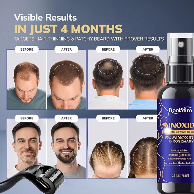 5% Minoxidil Hair Growth Kit for Men and Women: Extra Strength Minoxidil Hair Loss Treatment Serum with Rosemary for Faster Stronger Thicker Hair Growth 2 Fl Oz