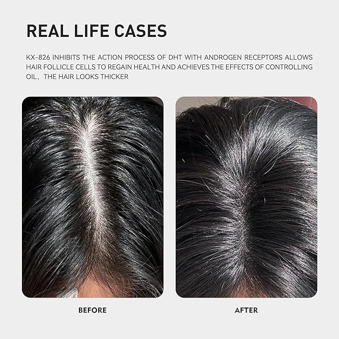 KINTOR 0.5% 0.9% KX-826 Hair Regrowth Spray,Reduce Fuller-looking Healthier Hair,Oil Control, Hair Care Products Group for Men&Women,3 Bottles, Basic,Plant-Based,Pro