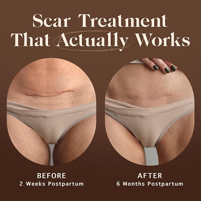 Nemah - C section scar treatment g