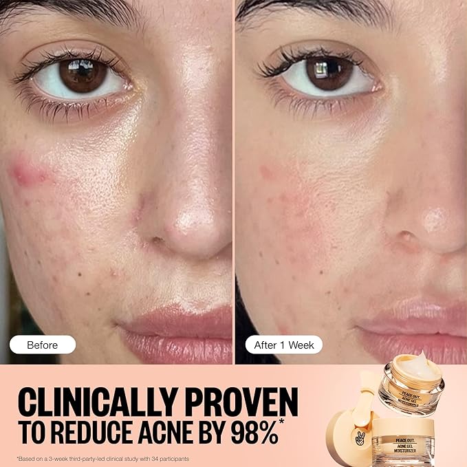 PEACE OUT Skincare Acne Gel Moisturizer, For Daily Facial Use with Salicylic Acid & Niacinamide, Boost Hydration and Help Prevent Acne & Blackheads, for Men & Women, 1.69 fl oz