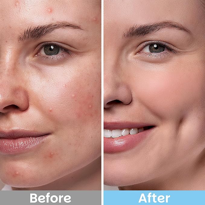 Salicylic Acid Exfoliating Facial Pads for Blemish-Prone Skin |Daily Pore Cleansing & Oil Control | Soothing Skincare Witch Hazel Toner Pads | 70 Count