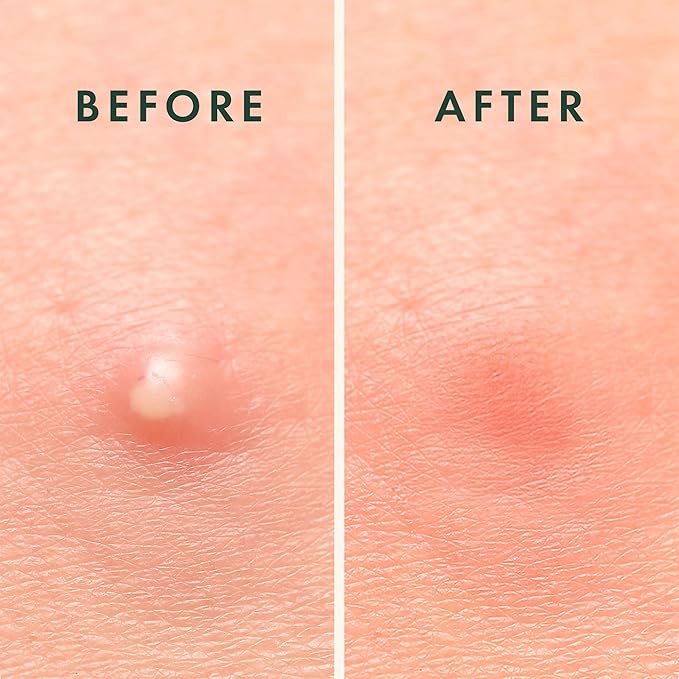 Rael Pimple Patches - Miracle Overnight Spot Cover, Thicker & Extra Adhesion, Hydrocolloid Acne Treatment for Face, Zits & Blemishes, Korean Skin Care, Vegan & Cruelty-Free, 3 Sizes (104 Count)