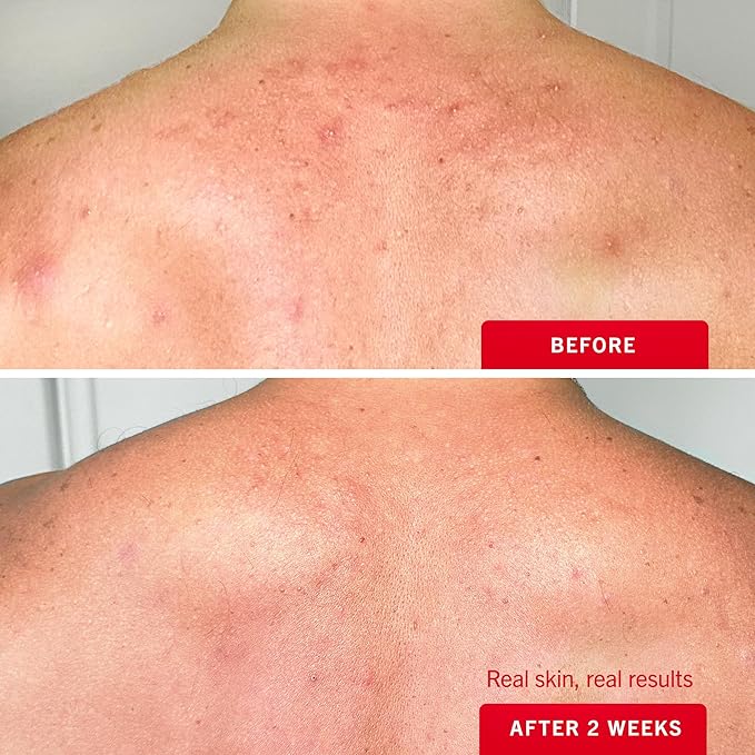 First Aid Beauty Body Acne Spray - Maximum Strength Body Acne Treatment With 360-Degree Sprayer - 2% Salicylic Acid Formula, (3.0 oz)